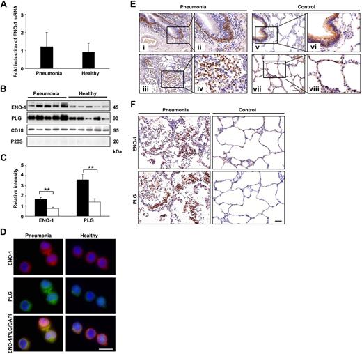 Figure 7. ENO-1 expression on blood monocytes and in lung tissue from pneumonia patients. (A) ENO-1 mRNA expression in blood monocytes obtained from pneumonia patients and healthy controls was assessed by real-time PCR. Results are expressed as fold-increase of the ratio of ENO-1/β-actin over control values (healthy controls) and are mean ± SD; n = 5. (B) Western blot illustrating cell-membrane localization of ENO-1 and PLG on blood monocytes from pneumonia patients and healthy controls. Streptavidin beads were used to separate biotinylated membrane proteins from nonbiotinylated cytosolic proteins. The purity of the cell-membrane fraction was assessed by probing the samples for P20S. CD18 was used as loading control. (C) Densitometric analysis of panel B. □ represents healthy subjects, while ■ represents pneumonia patients. **P < .01. (D) Cellular localization of ENO-1 and PLG in monocytes isolated from the blood of pneumonia patients and healthy controls. Original magnification 63×/1.32-0.6 oil objective. Bar size 5 μm. (E) Representative lung tissue sections from pneumonia patients (i-iv) and controls (v-viii) were stained for ENO-1. In lungs from pneumonia patients, strong immunoreactivity for ENO-1 was observed in basal bronchial epithelial cells (i,ii) and mononuclear cells (iii,iv). In lungs from control patients, ENO-1 staining was observed in bronchial epithelial cells (v-viii). Original magnification ×20 (i,iii,v,vii), or ×40 (ii,iv,vi,viii). Bar size 20 μm. Lung sections from 1 representative pneumonia patient and 1 control patient of 5 per group are illustrated. (F) Representative lung tissue sections from pneumonia patients and control patients stained for ENO-1 and PLG. Original magnification ×40. Bar size 20 μm.