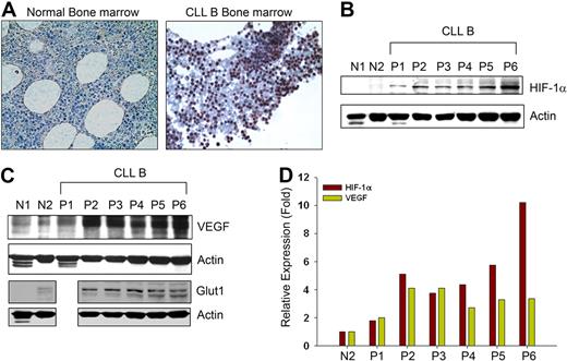 Figure 1. CLL B cells express constitutive levels of HIF-1α. (A) Immunohistochemistry of CLL and normal bone marrow for HIF-1α expression. Normal and CLL bone marrow sections were immunostained with a mouse monoclonal antibody to HIF-1α and counterstained with hematoxylin. Normal marrow cells show little or an undetectable level of HIF-1α while CLL bone marrow exhibit clusters of lymphocytes positive for HIF-1α expression with mostly nuclear staining. Figures shown are representative of 5 normal and 10 CLL bone marrows (magnification ×400). (B,C) CLL B cells express high levels of HIF-1α and its target genes under normoxia. Lysates prepared from CLL B cells (P1-6), normal PBMCs (N1), and purified normal B cells (N2) were analyzed for the expression of HIF-1α or VEGF by Western blot using specific antibodies. Expression of Glut1, another target gene of HIF-1α, is also shown in these samples (except CLL-P1) by Western blot analysis using a specific antibody to Glut1. Actin was used as the loading control. (D) Expression of HIF-1α and VEGF in CLL is positively correlated. Densitometric values of HIF-1α and VEGF expression in CLL B cells (B,C) were calculated and presented as relative expression based on the values obtained from the normal purified CD19+ B-cell lysates (panels B,C lane N2). Expression levels of HIF-1α and VEGF in normal B cells were arbitrarily chosen as one. Results demonstrate a generally positive association of HIF-1α and VEGF expression.