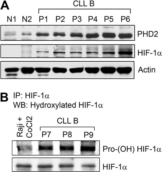 Figure 2. Prolyl hydroxylase enzyme is up-regulated and active in CLL B cells. (A) Constitutive levels of HIF-1α up-regulates PHD2 levels. Lysates prepared from CLL B cells (P1-6), normal PBMCs (N1), and purified normal B cells (N2) were analyzed for the expression of PHD2, a downstream target of HIF-1α, by Western blot using a specific antibody. Constitutive levels of HIF-1α in these samples are also shown. Actin was used as the loading control. (B) CLL B cells express heavily hydroxylated HIF-1α. CLL B-cell lysates (labeled as P7-9) were subjected to immunoprecipitation using a monoclonal antibody to HIF-1α. Immunoprecipitated protein was analyzed for posttranslational modification by Western blot using a polyclonal praline (564)–specific hydroxylated HIF-1α antibody. The blot was stripped and reprobed to detect immunoprecipitated HIF-1α. Raji cells pretreated with 100 μM CoCl2 for 6 hours were used as a negative control.