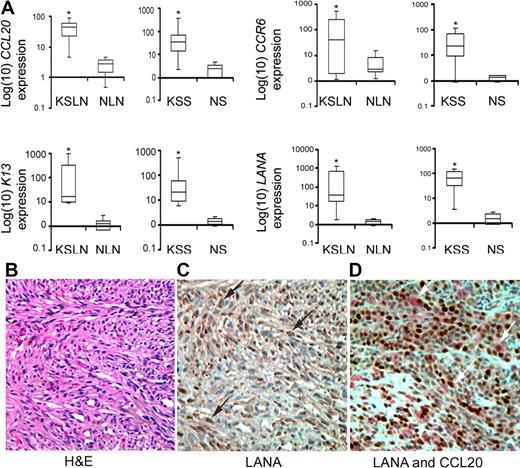 Figure 7. Up-regulation of CCL20 and its receptor CCR6 in KS samples. (A) Box-whisker plots with 95% confidence intervals for the RNA expression of CCL20, K13, LANA, and CCR6 in KSHV-infected patients' lymph nodes (KS lymph nodes, n = 5) and skin samples (KS skin samples, n = 10) along with corresponding benign lymph nodes (n = 6) and normal skin (n = 10) samples. Box-whisker plot indicates the median expression of respective genes relative to β-actin (line in the box) and their interquartile range (box). The whiskers present an entire range of expression level of indicated genes in a group, the upper value being the largest observation ≥ 75th percentile + 1.5 × (interquartile range), with the lowest value being the smallest observation ≤ 25th percentile − 1.5 × (interquartile range). The RNA was isolated from flash frozen tissues, and the expression levels of the indicated genes were determined by quantitative RT-PCR. The expression levels of CCL20 and its receptor CCR6 were significantly higher in the KS samples compared with corresponding uninfected controls (*P < .05, Mann-Whitney U test). Similarly, the expression level of LANA and K13, 2 key genes of KSHV infectivity, were significantly higher in KS samples than the corresponding healthy skin or lymph node samples (*P < .05, Mann-Whitney U test). (B) Hematoxylin and eosin staining shows the presence of characteristic spindle cells in a KS biopsy specimen. (C) Immunohistochemistry shows the presence of LANA-positive cells with typical brown punctate nuclear staining (black arrows) in the KS lesion. (D) Double immunostaining with LANA and CCL20 antibodies shows that a majority of CCL20-positive cells (red; white arrows) are positive for LANA (brown). (B-D) original magnification ×400.