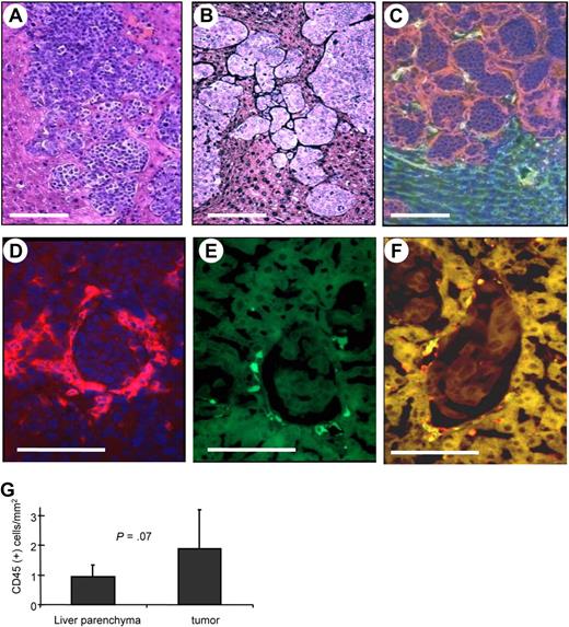Figure 6. Homing of human HSC progeny to liver metastases derived from human breast cancer cells. (A-C) Histology of liver metastases. Two weeks after intraportal MDA-MB435 cell transplantation, liver sections were stained with H&E (A), stained for stroma (black; B), or for laminin (red) and mouse CD31 (green; C). (B-F) Human CD34+ cells were transduced with a GFP-expressing lentivirus vectors and transplanted into sublethally irradiated CB17 SCID/beige mice. Six weeks later, mice received MDA-MB435 cells. Liver sections were analyzed 3 weeks later for laminin (red; D), GFP (green; E), and laminin and GFP (F). Notably, there were no specific fluorescence signals on liver/tumor sections of mice that did not receive LV-GFP–transduced bone marrow cells. The scale bar represents 100 μm. (G) Quantification of human donor cells in liver parenchyma and tumor stroma (N = 15; 5 mice, 3 sections per mouse). Error bars represent SD.