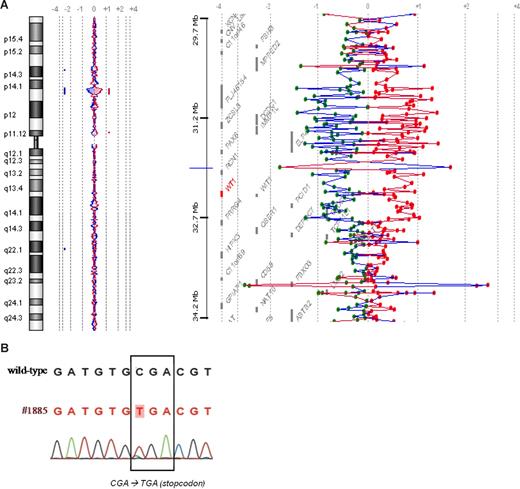 Figure 1. WT1 aberrations in patient no. 1885 detected by array-CGH and sequencing. (A) The left part of the figure shows a chromosome 11 ideogram and corresponding oligonucleotide array-CGH plot of the ratio of patient no. 1885 DNA and control DNA (blue tracing) versus the dye-swap experiment (red tracing) from an array-CGH experiment (105-K oligonucleotide array-CGH platform; Agilent Technologies, Palo Alto, CA). A cryptic 11p13 deletion of approximately 2.5 Mb is found, which area includes the WT1 gene. The right part of the figure zooms in on the deleted area and presents the genes located in this area. (B) Sequence analysis of patient no. 1885 showing a c.901C→T non-sense mutation on the remaining WT1 allele.