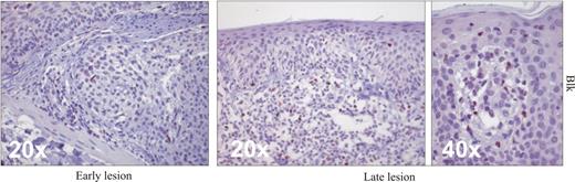 Figure 2. Ectopic expression of Blk in patients with early- and late-stage CTCL. Immunohistologic detection of Blk in early (left) and late (right) lesions of CTCL. Representative sections are depicted at original magnification ×20 and ×40.
