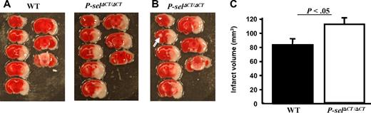 Figure 2. Stroke infarct volume is increased in P-selΔCT/ΔCT mice. Intraluminal MCAO model of stroke on P-selΔCT/ΔCT mice and age-matched sibling WT controls. (A) Representative photographs of TTC staining of sections showing enhanced infarct volume in a P-selΔCT/ΔCT mouse brain, compared with a WT mouse brain. (B) White arrow indicates small spontaneous infarct present in the uninjured hemisphere of 1 P-selΔCT/ΔCT mouse. (C) Quantitative image analysis of the infarction area. n = 7 in each group. Error bars indicate SEM.