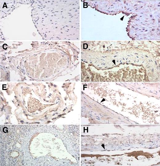 Figure 3. Immunohistochemistry of arteries and veins for ADAMTS-18. (A,B) Umbilical artery and vein, respectively. (C,E,G) Pulmonary vein and (D,F,H) artery, obtained from 3 different patient archival pathology specimens. depict positively stained endothelial cells for ADAMTS-18.