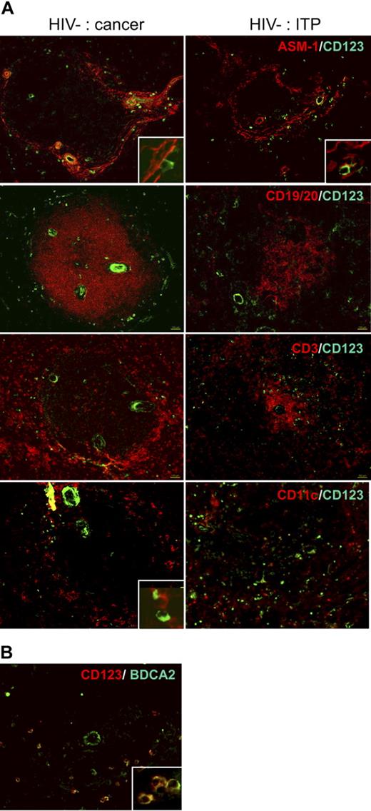 Figure 1. Distribution of pDCs in human spleen. (A) Labeling of serial spleen sections from a patient (patient C) with pancreatic cancer (left) and a patient (patient A) with ITP (right). Original magnification ×100; inset, ×400. (B) Colabeling of pDCs with CD123 and BDCA2. Original magnification ×200; inset, ×400.