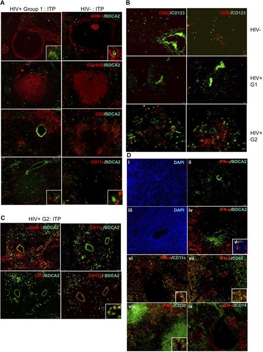 Figure 3. Localization and phenotype of pDC in HIV+ human spleens. (A) Comparative distribution of pDCs on serial sections from HIV− patient A (right panels) and HIV+ patient M (except for CD3/BDCA2 labeling done in patient N, left panel), both with ITP. Original magnification, ×100; inset, ×400. Results are representative of those found in 6 HIV− and 7 HIV+ patients. (B) pDCs have a nonactivated phenotype in HIV− and HIV+ patients. Serial spleen sections were labeled with CD83 and CD123 (left panels), CD86 and CD123 (right panels) in HIV− patient C (top panels), HIV+ group 1 patient O (middle panels), and HIV+ group 2 patient S (bottom panels). Original magnification ×100; bottom panels, ×200. (C) pDC accumulation in HIV+ patient S from group 2. Original magnification ×100; inset, ×400. (D) Most HIV+ patients, not HIV− patients, have IFN-α–producing cells in the marginal zone. Serial spleen sections were labeled for IFN-α and BDCA2, CD11c, CD68, CD20, or CD14. Sections from HIV− patient A (i,ii) and from HIV+ patients R (iii-v), M (vi,ix), and O (vii,viii). Original magnification ×100; insets, ×400; v, ×400. Pictures are representative of 4 HIV− and 6 HIV+ patients.