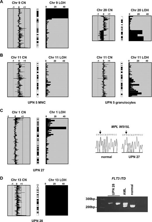 Figure 1. Single nucleotide polymorphism array results and initial mutation analysis. (A) Array analysis of 2 control patients showing copy number (CN) and loss of heterozygosity (LOH) outputs. The x-axis for the CN plots show (copy number)−2 as determined by CNAT, with values approaching or exceeding −1 indicating deletions and greater than +1 indicating amplifications. The x-axis for LOH shows log10 P values (ie, 20 indicates 10−20). The 2 panels on the left are from a polycythemia vera (PV) case with a homozygous V617F JAK2 mutation. There is no gross copy number change (individual datapoints spread around the zero line), but a large block of homozygous SNP calls at 9p indicative of aUPD. The 2 panels on the right are from a chronic myeloid leukemia (CML) blast crisis case and show LOH accompanied by a 20q deletion. (B) For case UPN 5, a large block of 11q aUPD is apparent on analysis of granulocytes but almost completely absent from mononuclear cells (MNCs) extracted from the same sample. (C) Chromosome 1p aUPD in case UPN 27 is associated with a biallelic G>T MPL mutation that is predicted to result in a W515L substitution. (D) Whole chromosome 13 isodisomy in case UPN 28 associated with a homozygous FLT3 ITD. Two controls are shown: an acute myeloid leukemia (AML) patient previously known to have a heterozygous FLT3 ITD and a healthy individual.
