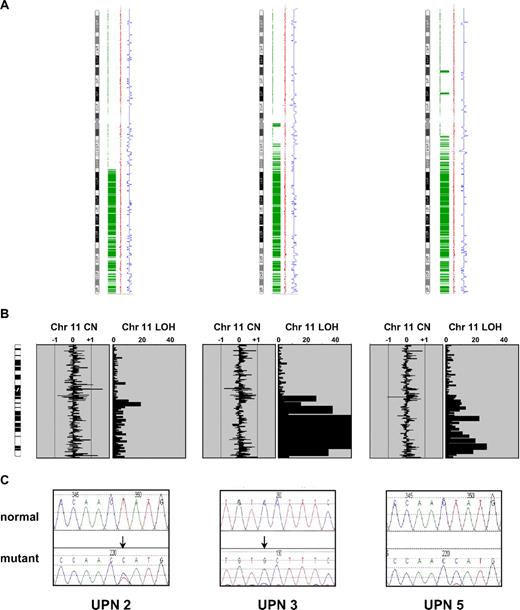 Figure 2. CBL mutations in the 3 cases with 11q aUPD. (A) Genotyping Console output indicating homozygous SNP calls in green, copy number state as estimated by a Hidden Markov Model in blue, and smoothed copy number log(2) ratio values in red. (B) Ideograms showing lack of large copy number changes and blocks of homozygosity at 11q. Abbreviations are as in Figure 1. (C) Sequence changes indicated by ↓ in each case compared with normal controls. UPN 2 and UPN 5 each have the c.1139T>C: L380P mutation whereas UPN 3 has c.1249C>G: P417A.
