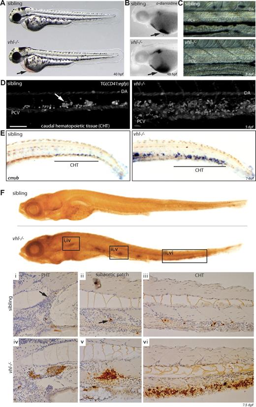 Figure 3. vhl mutants develop severe polycythemia. (A) vhl mutants develop a severe increase in circulating red blood cells (polycythemia), apparent by 40 hpf by blood accumulation under the heart on the yolk sack (). (B) o-Dianisidine blood staining at 48 hpf. (C) Circulating blood cells imaged just anterior to the cloaca. Whereas normally a single row of blood cells is transported through the dorsal aorta (DA) and posterior cardinal vein (PCV) at 8 dpf, several rows of circulating blood cells are observed in vhl mutants. Anterior is left. (D) Confocal analysis through the CHT (posterior to cloaca) of 5 dpf embryos expressing the CD41:egfp transgene reveals an enlarged population of CD41-GFP+ hematopoietic cells between the DA and PCV in vhl mutants. Anterior is left. Scale bar indicates 100 μm. (E) Whole-mount in situ hybridization for c-myb mRNA reveals an increase number of c-myb+ HSCs in the vhl−/− CHT at 7 dpf. (F) BrdU incorporation assays demonstrate increased proliferation in all hematopoietic tissues in 7.5 dpf vhl−/−, as shown in whole-mount and cross-sections (i-iii). Original magnifications, ×5 (A,B,E), ×20 (C,Fi-iii), and ×40 (D).
