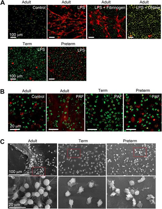 Figure 1. Stimulated PMNs isolated from newborn term or preterm human infants fail to form NETs. (A) NET formation was detected by live cell imaging with confocal microscopy using 2 DNA dyes, one cell impermeable (Sytox Orange, which stains extracellular DNA red in these images) and the other cell permeable (Syto Green, which identifies nuclear DNA) after activation of PMNs with LPS (100 ng/mL) for 60 minutes. Experiments were performed on poly-l-lysine– or fibrinogen-coated (top row, third panel) glass coverslips. DNase (2.5 Units/mL) was added following LPS stimulation (60 minutes) to dismantle extracellular NETs (top row, far right panel). The images are representative of experiments performed with LPS-stimulated PMNs isolated from 6 different donors from each subject group (adult, term, and preterm). Incubations on immobilized fibrinogen and treatment of LPS-stimulated PMNs with DNase were performed with neutrophils from 3 different adult subjects in each case. Control and LPS stimulation, 20× objective. (B) NET formation was detected as in panel A following stimulation of adult, term, and preterm PMNs with PAF (10 nM) for 60 minutes. These images are representative of separate experiments using PMNs isolated from 6 different donors in each subject group (adult, term, and preterm). Control and PAF stimulation, 60× objective. (C) NET formation was examined by scanning electron microscopy following stimulation of PMNs with LPS (100 ng/mL) for 60 minutes. These images are representative of 3 different experiments with PMNs from different donors in each subject group.
