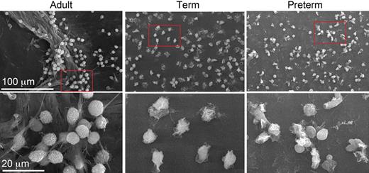 No NET formation in neutrophils from newborn babies. Yost et al examine NET formation by scanning electron microscopy following stimulation of isolated neutrophils with bacterial lipopolysaccharide (LPS). LPS-stimulated neutrophils from an adult donor were found to generate extensive extracellular lattices (left panels). In contrast, NET formation could not be detected when control or LPS-stimulated neonatal neutrophils were examined (middle panels: term; right panels: preterm). The net result of this novel defect was shown to be impaired extracellular killing of bacteria. See the complete figure in the article beginning on page 6419.