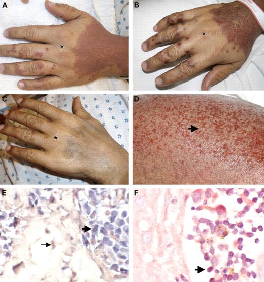 Figure 1. Pralatrexate induces skin erosions limited to areas affected by ATLL. (A) ATLL skin lesions with confluent erythematous papules of the dorsal hands with areas of sparing over knuckles (*). Pompholyx-like lesions on digits. Pictures were taken 3 days after the first dose of pralatrexate was given. (B) Skin erosions within affected areas 6 days after the first dose of pralatrexate was administered. (C) Resolution of rash with postinflammatory hyperpigmentation 3 months later. (D) Higher magnification of skin erosions (arrow) on the right leg 6 days after the first dose of pralatrexate. (E) In situ hybridization for HTLV-1 shows positive signal within atypical lymphocytes in the epidermis (bold arrow), whereas red counterstain is observed in dermal fibroblast (→; original magnification ×40). (F) Immunohistochemistry for HTLV-1 shows positive signal in atypical lymphocytes in Pautrier microabscesses (; original magnification ×40).
