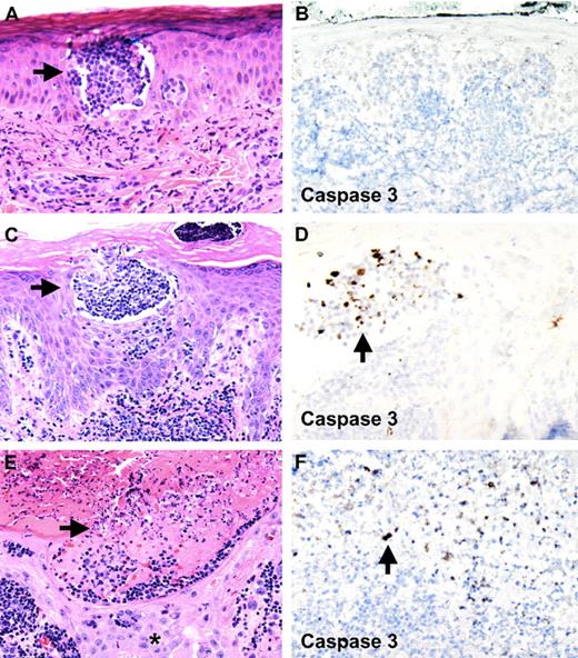 Figure 2. Pralatrexate induces tumor cell lysis within epidermal Pautrier microabscesses without affecting keratinocytes. Apoptosis of atypical lymphocytes is demonstrated with staining for activated caspase 3. (A,B) First skin biopsy of papule 2 months before initiation of pralatrexate therapy. Pautrier microabscess in epidermis is seen. No staining for activated caspase 3 is observed (original magnifications: A, ×10; B, ×10). (C,D) Skin biopsy 3 days after the first dose of pralatrexate was given shows atypical cells within epidermal Pautrier microabscesses undergoing apoptosis, whereas no activated caspase 3 staining is observed in adjacent keratinocytes (original magnifications: C, ×10; D, ×20). (E,F) Skin biopsy of skin erosion 6 days after pralatrexate therapy was initiated. Necrosis and cellular debris are seen within epidermal Pautrier microabscesses accompanied by positive staining for activated caspase 3. No necrosis is seen in adjacent keratinocytes (*, original magnifications: E, ×10; F, ×20). Slides were viewed with a Zeiss Axio Scope light microscope using N-ACHROPLAN objectives (10×/0.25, 20×/0.45, and 40×/0.65), and images were acquired with an AxioCam HR camera (Carl Zeiss AG). Images were processed using Image-Pro Plus version 5.0 (Media Cybernetics).