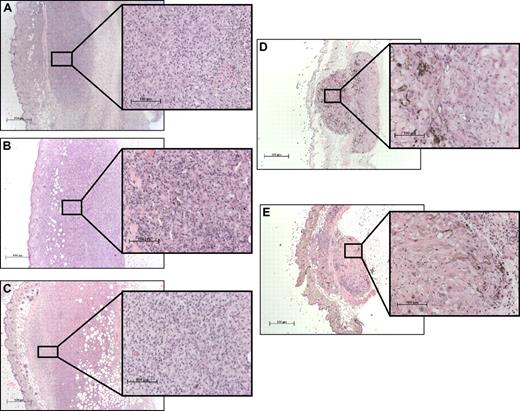 Figure 5. Histopathologic analysis of the vaccination site. (A) WT, (B) GM-CSF−/−, (C) IL-5−/−, and (D) βc−/− mice were immunized subcutaneously on the abdomen with 106 irradiated B16-GM cells. As control, WT mice were immunized with 106 irradiated B16 cells (E). Five days later, tissue samples were collected and fixed in formalin before paraffin embedding. Samples were then stained with hematoxylin and eosin. Magnification: 10 × 2.5 and 10 × 20.