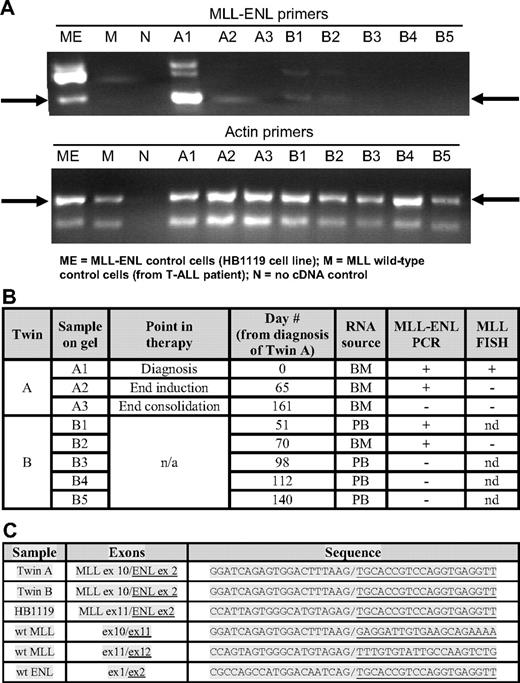 Figure 2. Laboratory results. (A) MLL-ENL RT-PCR for twins A and B with actin control. (B) Summary of MLL-ENL RT-PCR and MLL FISH results for twins A and B; BM indicates bone marrow; PB, peripheral blood; n/a, not applicable; nd, not done. (C) Sequencing results (wt MLL and ENL sequences included as reference).