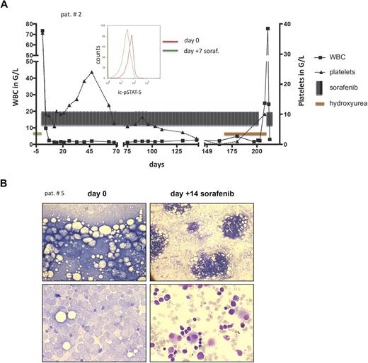 Figure 1. Sorafenib treatment response. (A) Patient 2: A fast response to sorafenib was associated with a dephosphorylation of the antiapoptotic FLT3-ITD target STAT-5, measured intracellularly in the blastic population by fluorescence-activated cell sorter (middle panel histogram): the left shift of the green curve documents a decrease in intracellular STAT-5 phosphorylation 7 days after commencing sorafenib compared with baseline (day 0, red line). Sorafenib was withdrawn on day 204 of sorafenib and hydroxyurea commenced because of a newly diagnosed cerebral mass. AML was resistant to hydroxyurea (peripheral white blood cell count increase to 75.6 × 109/L), but reexposure to sorafenib again led to an instant response (white blood cell count decline to 1.3 × 109/L). (B) Patient 5: Bone marrow light microscopy to evaluate bone marrow response (patient 5) before allo-SCT. Giemsa staining shows blast infiltration before (left panels) and extensive blast clearance 14 days after commencing sorafenib (right panels). Low and high magnification of bone marrow smear (top and bottom panels, respectively). Images were viewed with an Olympus BH-2 microscope using Giemsa stain; left panel, 10×/0.3 numeric aperture (NA); right panel, 60×/1.4 NA oil objective. Images were taken with a Sony Exwave HAD camera using DHS Bilddatenbank software (Dietermann & Heuser Solution GmbH, Greifenstein-Beilstein, Germany).