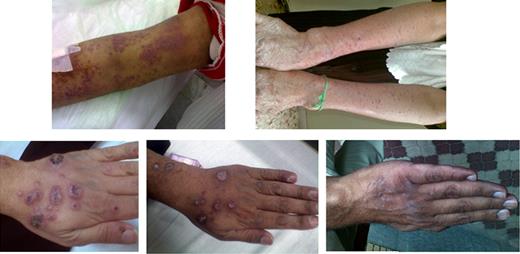 Figure 1. Treatment with arsenic, interferon, and zidovudine results in rapid resolution of ATL skin manifestations. (Top panels) Representative skin manifestations in patient 1 at diagnosis (left) and after 1 month of therapy (right). (Bottom panels) Representative skin manifestations in patient 3 at diagnosis (left), after 2 weeks of therapy (middle), and after 8 months of therapy (right).