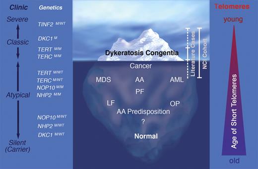 Clinical spectrum and genetics of dyskeratosis congenita (DC). Since the identification of the DC genes and the application of genetic testing, it is increasingly recognized that the classic DC clinical features represent the “tip of the iceberg” and are present in only a small proportion of patients. Instead, a substantial proportion of patients present without mucocutaneous manifestations, but with aplastic anemia (AA) or myelodysplastic syndrome (MDS). In other patients, extrahematopoietic manifestations may be the primary or only manifestations of disease, such as pulmonary fibrosis (PF), liver fibrosis (LF) or osteoporosis (OP). In rare cases, certain types of cancer occur at unexpectedly young ages or acute myeloid leukemia (AML) is the presenting feature. In addition to clinically affected individuals, a significant population of silent mutation carriers exists with no obvious disease manifestations. Clinic represents the clinical spectrum from silent mutation carriers to individuals with severe disease manifestations. The triangle on the right illustrates the age when telomeres become critically short; in severe disease, telomeres are short at a young age, whereas in individuals with mild disease, telomeres become critically short later in life. M indicates mutant; and WT, wild type. Professional illustration by Marie Dauenheimer.