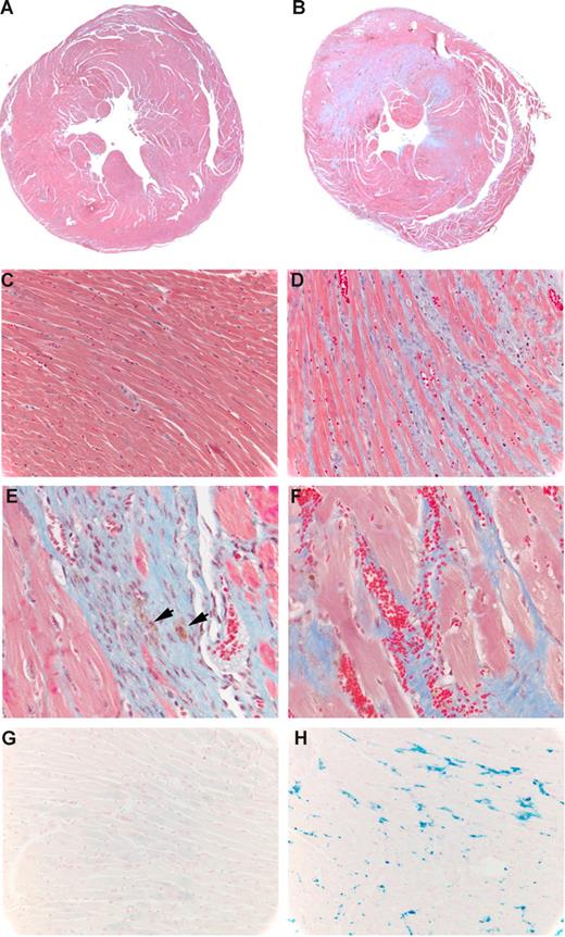 Figure 3. Evaluation of cardiac fibrosis and bleeding in TF-deficient mice. (A-F) Masson trichrome staining of 10-week hearts from TFflox/flox (A,C) and TFflox/flox/SM22αCre+/− (B,D-F) mice. (A,B) Low-power (1.25×/0.04 PlanAPO) cross sections taken midway through the left ventricle. (C,D) Higher-power (40×/0.30 UPlanFL) sections from the same hearts. (E,F) Further magnifications (40×/0.30 UPlanFL) from panel B showing hemosiderin (arrows) and active hemorrhage (red blood cells). Fibrosis appears as blue. (G,H) Prussian blue (Perls Ferric Iron) staining (40×/0.30 UPlanFL) of TFflox/flox (G) and TFflox/flox/SM22αCre+/− (H) mice.
