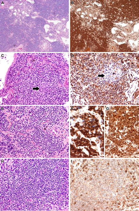Figure 3. Validation of gene expression profiling by IHC. (A,B) Case 5 showing strong cytoplasmic expression of MMP7. (A) H&E; (B) MMP7. (C,D) Case 11 showing strong cytoplasmic expression of SIGLEC6 by the tumor cells. A reactive follicle () included in the section is negative for SIGLEC6. (C) H&E; (D) SIGLEC6. (E-G) Case 14 with IGH/MALT1 translocation and spiked expression of RARA showing strong staining for MALT1 and RARA. (E) H&E; (F) MALT1 immunostain; (G) RARA. (H,I) Case 7, which lacked spiked RARA expression by gene expression profiling, is also negative for RARA by IHC. Plasma cells seen scattered through the tumor express RARA. (H) H&E; (I) RARA. All photographs were taken with a DP70 Olympus camera (Olympus, Tokyo, Japan) using an Olympus BX51 microscope (Olympus); images were acquired using DP Controller 2002 (Olympus) and processed using Adobe Photoshop version 7.0 (Adobe Systems, San Jose, CA). Original magnifications: ×100 (A,B), ×400 (C-I).