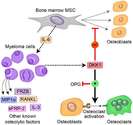 Figure 4. Metastatic cancer cells that secrete elevated levels of DKK1 disrupt the balance of osteoblastogenesis and osteoclastogenesis in favor of an osteolytic microenvironment that is conducive to tumor growth. MM has a unique and absolute requirement for the bone marrow microenvironment for its growth and survival and MM plasma cells may cultivate this “soil” by synthesizing and secreting DKK1. The primary effect of DKK1 appears to be the disruption of the differention of MSC in the osteoblasts (OB). RANK signaling regulates osteoclast development and Wnt signaling in MSC/OB differentially regulates RANKL and OPG, a RANKL decoy, which together modulate osteoclast development. DKK1 suppression of Wnt in MSC/OB leads to increased production of RANKL and IL-6 and decreased production of OPG. The shift in RANKL:OPG ratios leads to increased osteoclastogenesis and IL-6 is a potent survival factor of MM cells. The subsequent loss of osteoblasts and increase in osteoclasts causes lytic bone destruction, hypercalcemia, and loss of normal bone marrow function. A vicious cycle of bone destruction and tumor growth ensues. The absence of DKK1 in a subset of MM suggests that other soluble factors produced by MM cells may contribute to this process. These include MIP1a, sFRP-2, IL-3, RANKL, and possibly sFRP-3 (see “Proposed model of DKK1-mediated promotion of bone metastases” for more details).