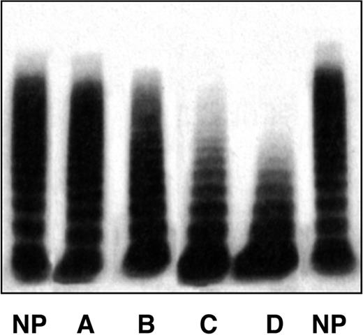 Figure 1. The 4 multimeric patterns found in the entire cohort of VWD2B patients. Pattern A indicates all HMW multimers present, as in plasma of normal persons; pattern B, partial loss of the HMW multimers; pattern C, complete loss of HMW multimers; pattern D, loss of high and intermediate multimers. Pattern A is identical to that of normal plasma (NP).