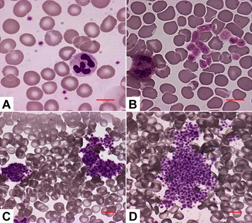 Figure 2. The 4 platelet morphology patterns identified in the VWD2B patients. (A) No abnormalities of platelet size or distribution. (B) Enlarged platelets, no platelet aggregates. (C) Some platelets are associated to form small platelet aggregates. (D) Most platelets are associated to form large platelet aggregates. Microscopy was performed through the Axioscope 2 Plus microscope (Carl Zeiss, Gottingen, Germany), using a 20×/0.50 Plan Neofluar or a 63×/1.25 Plan Neofluar oil-immersion objective (Carl Zeiss), and the Eukitt mounting medium (Bio-Optica, Milan, Italy). Images were acquired by the Axiocam MRc camera (Carl Zeiss) and the Axiovision 4.5 software (Carl Zeiss).