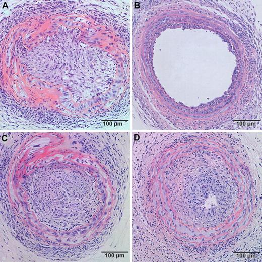 Figure 3. Effect of human apo A-I transfer on allograft vasculopathy in chimeric C57BL/6 SR-BI+/+ mice and chimeric C57BL/6 SR-BI−/− mice. Representative sections of allograft vasculopathy at day 21 after transplantation in control (A,C) and AdA-I (B,D)–treated C57BL/6 mice with SR-BI+/+ (A,B) or SR-BI−/− (C,D) bone marrow.
