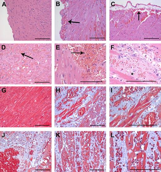 Figure 4. Intramuscular cardiac hemorrhage, necrosis, and inflammatory infiltrates are uniformly associated with Cre-mediated loss of prothrombin in Mx+fIIlox/− mice. Representative hematoxylin/eosin-stained heart sections from a wild-type mouse (A) and Mx+fIIlox/− mice 4 to 6 days after poly I:C induction of hepatic Cre recombinase (B-F). Note that loss of prothrombin resulted in widespread intramuscular cardiac hemorrhage (B-F) as well as frequent subepicardial bleeding events (B,C). Large areas of the myocardium exhibited evidence of hemorrhage, infiltration of neutrophils, and ischemia/necrosis (D,E; arrows). (F) High-power view of hemorrhagic lesion with severe disruption of tissue architecture. *Ischemia/necrosis within myocardium often resulted in the formation of large acellular regions. Representative Masson trichrome-stained heart sections from a wild-type mouse (G) and Mx+fIIlox/− mice 4 to 6 days after poly I:C induction of hepatic Cre recombinase (H-L). In addition to focal hemorrhage, the normal cardiac structure in prothrombin-depleted mice was often disrupted by widespread areas of amorphous plasma and matrix proteins (blue regions) (H-L). (I) A high-powered view of the region in panel H illustrating free red blood cells and the disruption of the muscle fibers. (J) Hemorrhagic lesion where ischemic/necrotic myocardium has been replaced by amorphous proteinaceous exudate. (K) Areas of hemorrhage and ischemia often tracked between tissue planes to disturb large regions of the heart. (L) High-power view of the region in panel K showing hemorrhage, neutrophils, and disruption of muscle fibers. Scale bars represent 100 μm.