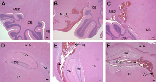 Figure 5. Parenchymal hemorrhage in the brain after disruption of the fII gene. (A) Normal hindbrain and cerebellum from a control mouse. (B,C) Brain sections taken from Mx+fIIlox/− mice 4 to 6 days after poly I:C. A frequent site of hemorrhage in the brain parenchyma was the medulla and the hindbrain near the cerebellum. (D) Normal hippocampal formation in a wild-type mouse. (E,F) Hemorrhage was observed in and around the hippocampal region and into the lateral ventricles in mice with conditionally deleted fII. *Areas of hemorrhage. MED indicates medulla; CB, cerebellum; MB, midbrain; CTX, cortex; CA, Ammon horn; DG, dentate gyrus; Th, thalamus; VL, lateral ventricle. Scale bars represent 100 μm.