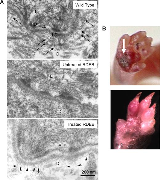 Figure 3. High-dose CD150+CD48− BM from Col7a1 wild-type congenic donors corrects basement membrane zone defect. (A) Anchoring fibrils are fan-shaped structures in the skin that are composed of col7 protein. Transmission electron microscopy demonstrates that anchoring fibrils emanate from the papillary dermis into the lamina densa (top panel, arrows) in the wild-type skin (as expected), and in the skin of treated RDEB animals (bottom panel, arrowheads). No anchoring fibrils are deposited at the skin basement membrane zone in the RDEB skin (middle panel). D indicates dermis; E, epidermis; LL, lamina lucida; LD, lamina densa; and HD, hemidesmosome. (B) Skin blisters characteristic of RDEB healed in all 3 long-term surviving Col7a1−/− recipients of CD150+CD48− BM (top panel, arrow points to a skin blister at 3 days of age; bottom panel, 10 weeks of age). Representative examples are shown. Camera: Coolpix 4300 (Nikon, Tokyo, Japan).