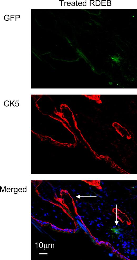 Figure 5. Donor GFP+ cells are not localized in the hair follicles of the skin. Immunofluorescence staining of the skin of the animals treated with GFP+CD150+CD48− BM infusion shows that GFP+ donor cells have localized outside of the hair follicles. Donor cells were visualized using anti-GFP antibody (green, top panel), and hair follicles were visualized using an anti–cytokeratin 5 antibody (red, middle panel). Donor cells and hair follicles are shown (vertical and horizontal arrows, respectively) on the image merged with blue DAPI nuclear stain (bottom panel).