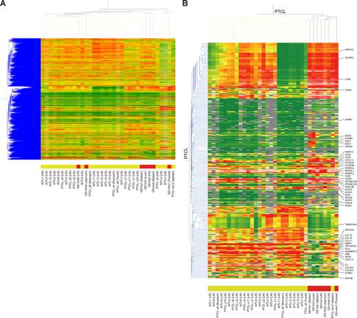 Figure 1. Hierarchical clustering of gene expression data. (A) Hierarchical clustering of 34 cases of PTCL using unsupervised analysis. Color blocks indicate the characteristics of the PTCLs; red blocks, γδTCL cases; amber blocks, αβTCL cases. The anatomic site of each specimen is shown in parentheses. AITL indicates angioimmunoblastic TCL; GD-hs, hepatosplenic γδTCL; GD-nhs, nonhepatosplenic γδTCL; LN, lymph node; PTCL hs, hepatosplenic αβTCL; PTCL u, PTCL-unspecified. Four cases of hepatosplenic γδTCL (GD-hs1-4) were classified into a single cluster. Nonhepatosplenic γδTCLs (GD-nhs5, intestinal; GD-nhs6, cutaneous; GD-nhs7, thyroidal) were scattered within the αβTCL distribution. (B) Hierarchical clustering of 34 cases of PTCL-based TCR signature gene expression. Genes also listed in Table 1 are shown on the right. γδTCL cases were correctly identified by the gene set, although one case of hepatosplenic αβTCL (PTCL hs12) was grouped with the γδTCLs.