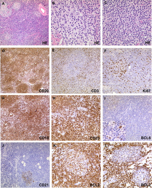 Figure 1. Morphologic and immunohistochemical features of FL with predominantly diffuse growth pattern. (A) A diffuse infiltration pattern prevails with only few intermingled atypical follicles. In the neoplastic follicles, centrocytic cells dominate (B), whereas in the diffuse areas tumor cells present with rounder nuclear contours (C). Tumor cells express CD20 (D), and reactive T cells (CD3) are prominent in diffuse areas (E). (F) The proliferative activity (Ki-67) is accentuated in the atypical follicular structures and decreased in the diffuse infiltrates. CD10 is expressed in atypical follicles and diffusely infiltrated areas in the majority of cases (G), as is CD23 (H). (I) BCL6 expression can be observed in all atypical follicles and in the nuclei of some interspersed B cells in the diffuse infiltrates. CD21 highlights FDCs in the atypical follicle. No CD21 staining is observed in the diffuse infiltrate (J). BCL2 expression is variable between cases but also within different areas of the same case (K,L). Magnification: panels A, D-G, I,J: ×200; panels B,C,H,I (inset), K,L: ×400.