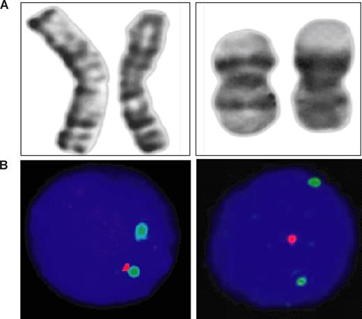Figure 2. Cytogenetic alterations affecting the chromosomal region 1p36 in FL with a predominantly diffuse growth pattern. G-banded pairs of chromosome 1 (cases 1 and 4, see Table 3) with structural alterations affecting the short arm (A). Representative FISH results on isolated nuclei from paraffin-embedded tumor tissue are shown for when the BAC probe RP4-755G5 for the chromosomal region 1p36 (red signal) and the YAC probe 968g8 for the region 1p22 (green signal) are used. Loss of genetic material in 1p36 is evident, whereas 2 copies of the region 1p22 are retained (B).