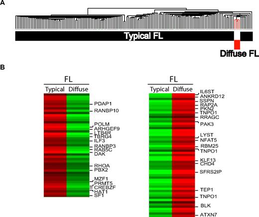Figure 4. Gene expression profiling of FL with predominantly diffuse growth pattern. (A) Hierarchical clustering demonstrates that gene expression profiles of diffuse FL fall into the spectrum of typical FL but nevertheless show a distinct gene expression signature. (B) Top 100 probe sets that are differentially expressed between typical FL and diffuse FL (according to the results of a t test between the groups).