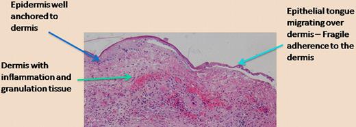 Epidermal migration over a chronic wound. The photomicrograph shows the histology of a chronic wound in which the epidermis migrates over the inflamed and vascular dermis. The separation of the epithelial tongue from the underlying dermis is an artifact from tissue preparation, but it properly suggests that the anchoring is diminished in order to allow keratinocyte migration to occur. (H&E; ×200.)