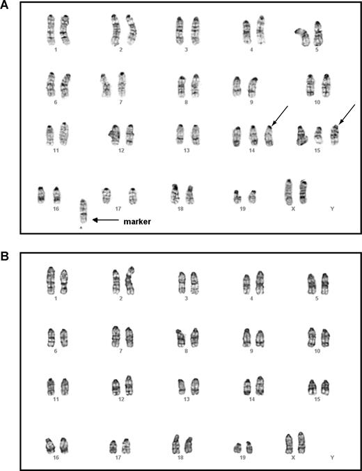 Figure 6. Malignant T cells and myeloid cells isolated from the same mouse displayed different karyotypes. Lymphoma T cells and malignant myeloid cells were isolated from the same animal that received a transplant of purified HSCs expressing oncogenic Kras from its endogenous locus and that developed both T-cell lymphoma and JMML (Table 1). Mouse chromosomal G-banding analysis was performed on these cells (“Methods”). A total of 18 thymic lymphoma cells were analyzed; all displayed the same karyotype. A representative image of a thymic lymphoma cell (A) showed trisomy chromosomes 14 and 15 (indicated by →) as well as gain of a fused mysterious chromosome (indicated by → labeled with marker). A total of 20 myeloid cells were analyzed; all showed apparently normal karyotype (B).
