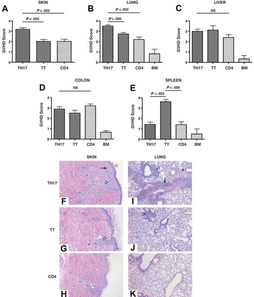 Figure 4. TH17 cells induce severe pathologic skin and pulmonary lesions. TH17 cells (5 × 106; n = 6), whole splenic T cells (5 × 106; n = 4), or CD4+/CD25− (5 × 106; n = 5) cells were transferred with T cell–depleted bone marrow cells into lethally irradiated B6D2 recipients. At day 14 after transplantation organs were harvested and processed as described in “Methods.” Histopathologic assessment of the skin (A), lung (B), liver (C), colon (D), and spleen (E) was performed by one author (A.P.-M.) who was blinded to the identity of the transplanted mice. Values presented are the mean plus or minus SEM for each group. Score range for each tissue, 0-4. Representative pictures of skin from animals receiving TH17 cells (F), total T cells (G), or CD4+/CD25− cells (H). → denotes epidermal hyperplasia, ▿ denotes follicular obliteration. Representative pictures of lung from animals receiving TH17 cells (I), total T cells (J), or CD4+/CD25− cells (K). → denotes perivascular cuffing and vasculitis, ▿ denotes peribronchiolar cuffing, ★ denotes area of alveolar hemorrhage. TT = total T cells, CD4 = CD4+/CD25− cells. Original magnification: skin = ×200, lung = ×100.