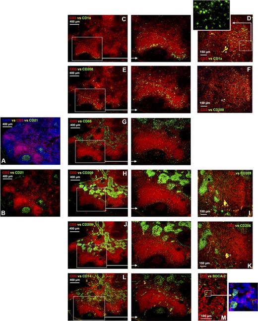 Figure 1. APCs expressing different markers colonize distinct areas of the human axillary lymph node. Frozen lymph node sections were probed with antibodies detecting CD3 and CD21 to identify the T lymphocyte–rich paracortex and follicles, respectively, thus providing anatomical definition (A,B). Within the paracortex, T lymphocytes were densely packed in some regions and more diffuse in others (A,B). Immunohistochemistry illustrated that cells expressing CD1a were either concentrated in diffuse T-lymphocyte zones surrounding the dense T-lymphocyte regions (C) or evenly distributed throughout areas densely packed with T lymphocytes (D). Cells expressing low and high levels of CD1a were detected (D, inset). CD208+ cells colonized similar areas to cells expressing CD1a (E,F). Dense bodies of cells expressing CD68, CD209, CD206, and CD14 were located in the medullary cords (G-L). Less frequent cells expressing CD68, CD206, and CD209 were also detected in the diffuse T-lymphocyte regions surrounding the medullary cords and follicles (G-K). Cells expressing CD68 or CD14 were also detected in the follicles (G,L). Rare BDCA-2+ plasmacytoid APCs were detected in the paracortex (M). Panels A to C, E, G, H, J, and L were acquired from the same area on sequential sections as were panels D, F, I, and K. Blue represents DAPI staining of cell nuclei (A,M, inset). *Background autofluorescence. Data are representative of 5 independent experiments. BDCA-2+ APC data are representative of 3 independent experiments.
