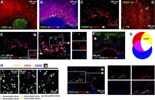 Figure 2. APC populations expressing a similar phenotype to cutaneous migratory APCs were detected in the paracortex of the human axillary lymph node. Frozen lymph node sections were probed with antibodies detecting CD3 and CD21 to identify the T lymphocyte–rich paracortex and follicles, respectively (A). Immunohistochemistry illustrated that a subset of CD1a+ APCs in the paracortex (B) coexpressed CD207 or Langarin (C). CD207+ APCs were either concentrated in the diffuse T-lymphocyte zones surrounding dense T-lymphocyte regions (B,C) or distributed throughout areas densely packed with T lymphocytes (D). Proportions of both CD1a+CD207− and CD1a+CD207+ APCs coexpressed CD208/DC-LAMP; however, not all CD208+ cells expressed CD1a or CD207 (E). APCs expressing CD1a or CD208 did not coexpress CD68 (F). Differing expression patterns of CD1a, CD207, and CD208 can therefore be used to distinguish between 3 APC populations in the paracortex: CD1a+CD207−CD208+/−, CD1a+CD207+CD208+/−, and CD208+CD1a−CD207− APCs (G). Subsets of CD1a+CD207− and CD1a+CD207+ APCs (H) and the majority of CD1a−CD208+ APCs (I) expressed the lipid presentation molecule CD1b. Cells expressing CD1b but no CD208 or CD1a were rare (I). Panels A to C, E, F, and I were acquired from the same area on sequential sections. The images shown in panel H were acquired from different fields. *Background autofluorescence. Data are representative of 5 independent experiments.