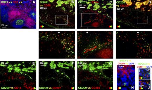 Figure 4. APCs expressing a similar phenotype to the APCs in medullary cords were also detected in the paracortex of the human axillary lymph node. Anatomical definition was obtained by staining frozen lymph node sections with antibodies detecting CD3 and CD21 to identify the T lymphocyte–rich paracortex and follicles, respectively (A). Sequential sections were probed with a panel of antibodies to defining APC markers (B-G). In addition to the CD209+ APCs in the medullary cords, cells expressing low-level CD209 colonized the diffuse T-lymphocyte areas surrounding the medullary cords and follicles (B-G). The majority of CD209lo APCs in the diffuse T-lymphocyte zones coexpressed CD68 (B), whereas CD14 (C) and CD206 (D) expression was variable. These CD209lo APCs did not express CD1a (E), CD207 (F), CD208 (G), or BDCA-2 (H). BDCA-2+ APCs also lacked CD68 expression (I,J). Panels A to G were acquired from the same area on sequential sections. Blue represents DAPI staining of cell nuclei (A,H-J). Data are representative of 4 independent experiments. BDCA-2+ APC data are representative of 3 independent experiments.