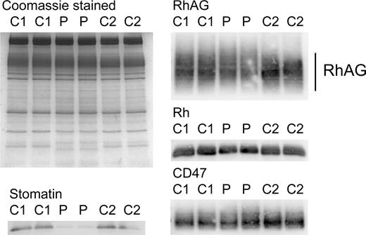 Figure 1. Red cell membrane protein analysis. Red cell membranes were separated on 10% Laemmli gels and Coomassie stained or immunoblotted using antibodies as shown. Loading: C1, C2, controls 1 and 2. P indicates proband (Stockport A-II-1). The RhAG is heavily glycosylated (seen as a broad 50- to 80-kDa band). In the proband, the amount of RhAG was reduced and the band was slightly shifted, suggesting hyperglycosylation. The Rh polypeptides were also reduced in expression, in proportion to the reduction of RhAG. CD47 appears unchanged. The reduction in stomatin has been shown previously and is characteristic of OHSt.