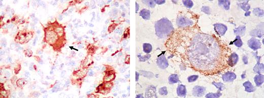 Figure 3. Expression of EBV LMP1 in the Reed-Sternberg cells of Hodgkin lymphoma. The immunostaining with LMP1 antibody is cytoplasmic (arrows). Original magnifications: ×400 (left), ×1000 (right). Images kindly provided by Dr L. Young, Birmingham. Images were assembled using Adobe Photoshop 6 (Adobe Systems, San Jose, CA).