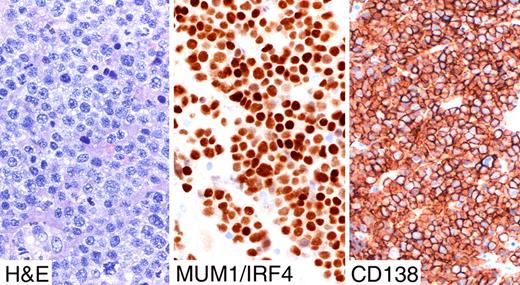 Figure 5. Strong immunostaining with the plasma cell markers CD138/syndecan1 and MUM1/IRF4 in plasmablastic lymphoma. Images were taken using a Nikon Eclipse 80i microscope (Nikon, Tokyo, Japan) with a pan fluor 40×/0.75 objective and Nikon digital sight DS-Fi1 camera equipped with control unit-DS-L2 (Nikon). Images were assembled using Adobe Photoshop 6 (Adobe Systems).