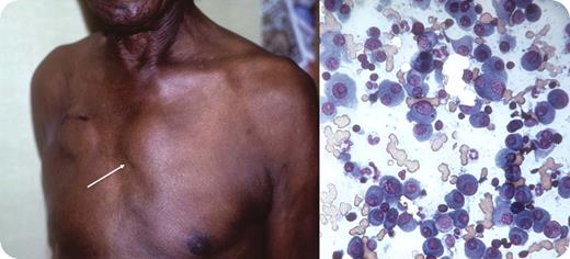 A 67-year-old man had a number of vague cardiac symptoms. When syncope and an arrhythmia occurred, a temporary pacemaker was promptly placed. At the time of the implantation of a permanent pacemaker, physical examination showed a parasternal mass on the left side of the upper sternum (see arrow); the site of the recently implanted pacemaker is medial to the right axilla. He admitted to having lethargy and generalized bony aches, but no fever, sweats, or weight loss. The mass was firm and fixed to the lateral margin of the sternum. He had no adenopathy, hepatosplenomegaly, or prostate nodules. Chest x-ray showed no pulmonary masses but did reveal osteoporosis and suspicious lytic bone lesions. On laboratory evaluation, there was mild anemia and azotemia, a normal prostatic specific antigen, and an elevated total protein. / A needle aspiration, culture, and smear of the parasternal mass were performed. The touch preparation smear (see aspirate photo) showed abundant plasma cells. Cultures were negative. On serum electrophoresis, a monoclonal protein was present; subsequently, it was identified as IgA lambda. / An isolated plasmacytoma presents infrequently. In this patient, the plasmacytoma appeared concurrently with the presence of multiple myeloma. The finding of a cardiac arrhythmia coupled with a lambda chain myeloma abnormality raised the possibility of cardiac amyloidosis. This possibility was assessed by cardiac ultrasound, but it was not present.