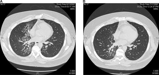 Figure 1. Pneumonitis after retreatment with ipilimumab. CT scans of the chest from patient 3520 (dose level 3.0 mg/kg). Scans show (A) an extensive inflammatory infiltrate that developed approximately 6 weeks after retreatment with ipilimumab and (B) complete resolution of changes after corticosteroid therapy.