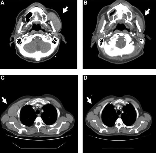 Figure 2. Regression of malignancy in a patient with mantle cell lymphoma. CT scans from patient 0414 (dose level 1.0 mg/kg) showing left parotid (A,B), and right axillary (C,D) nodal masses before (A,C) and 1 month after (B,D) ipilimumab infusion.
