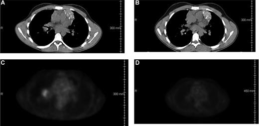 Figure 3. Regression of malignancy in a patient with HD. CT scans (A,B) and PET scans (C,D) from patient 2517 (dose level 3.0 mg/kg) showing right hilar adenopathy before (A,C) and 2 months after (B,D) ipilimumab infusion.
